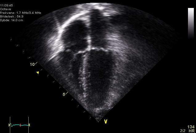 Echocardiogram 4chambers